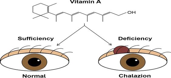 Chalazion: Symptoms, Causes, Treatments